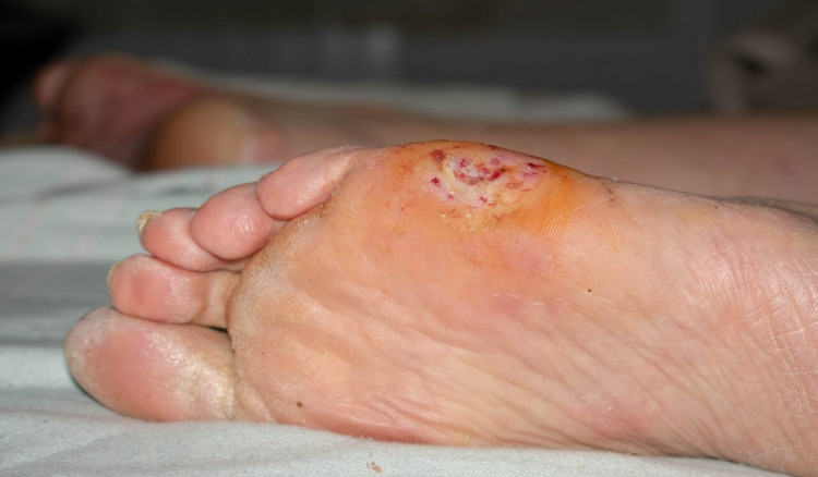 Diabetes Foot Infections