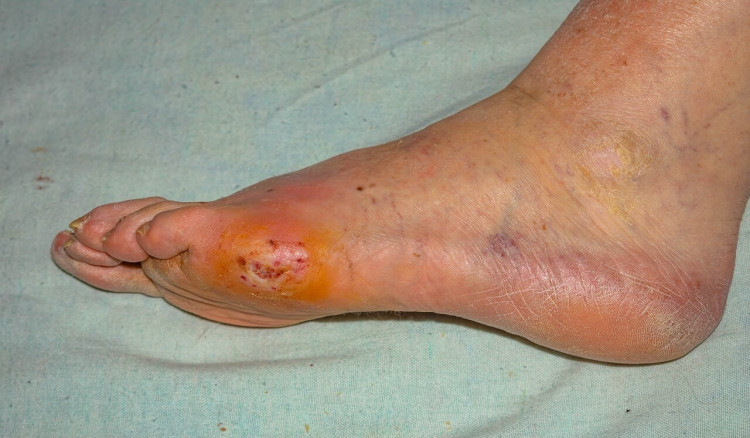 Diabetes Foot Ulcers