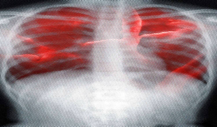 Pneumonia and Tuberculosis: Types, Symptoms and Treatment