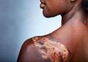 Types And Treatment Of Burns